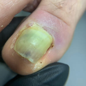Травма ногтя лечение у Врача подолога в Липецке